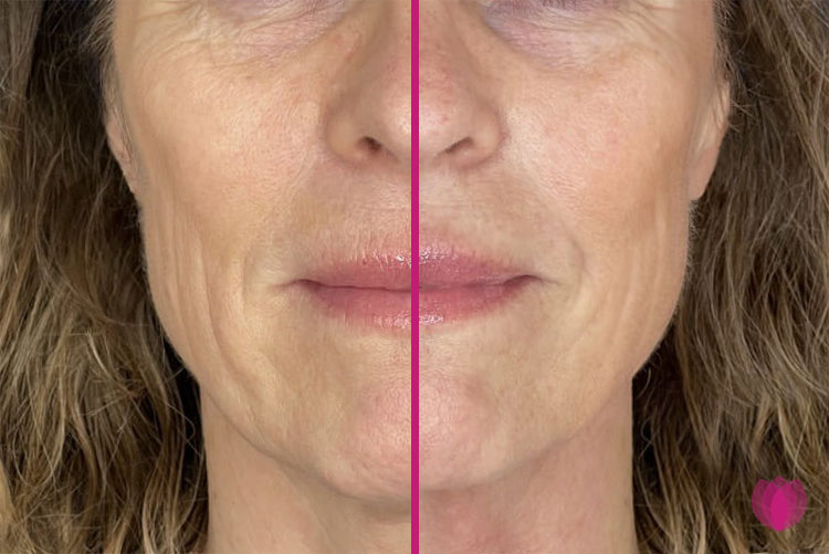 profhilo voor na, before after, profhilo resultaat, profhilo behandeling